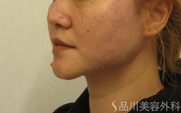 症例NO.72165のAFTER写真