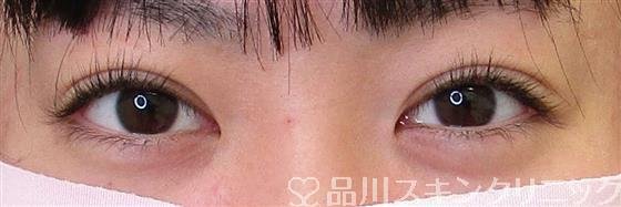 症例NO.61887のAFTER写真