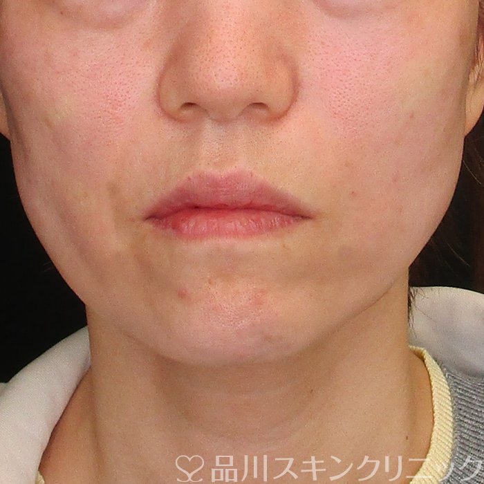 症例NO.73838のAFTER写真