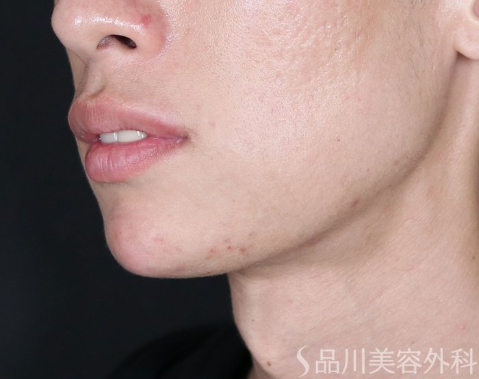 症例NO.73972のAFTER写真