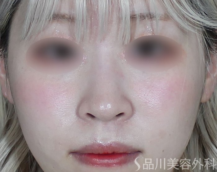 症例NO.69657のBEFORE写真
