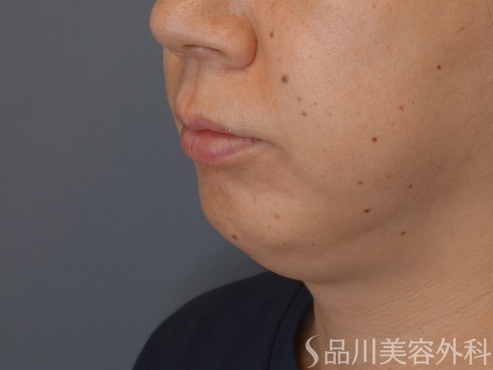 症例NO.71006のBEFORE写真