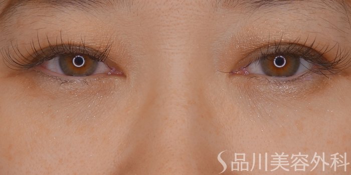 症例NO.69678のAFTER写真