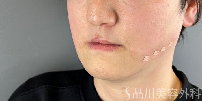 症例NO.73140のAFTER写真