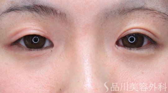 症例NO.63558のBEFORE写真