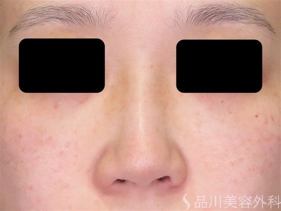 症例NO.49056のBEFORE写真