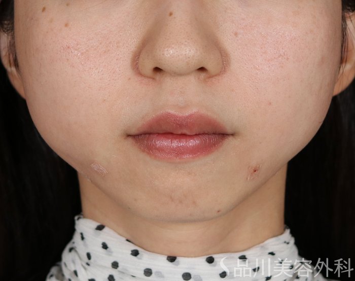 症例NO.71135のAFTER写真