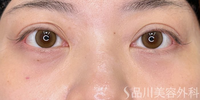症例NO.74750のAFTER写真