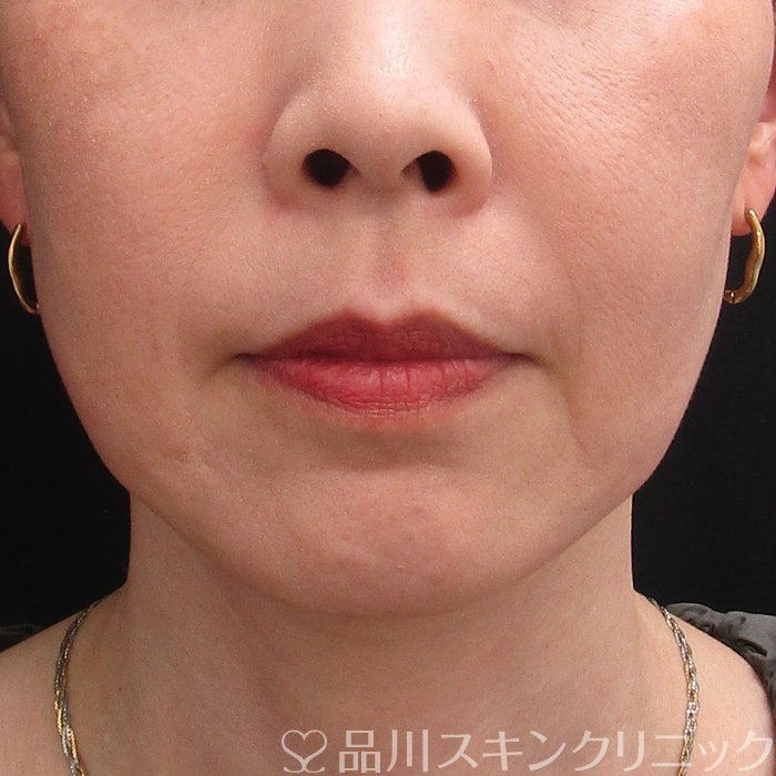 症例NO.73430のBEFORE写真