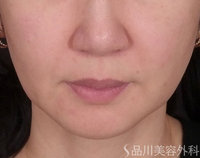 症例NO.68529のBEFORE写真