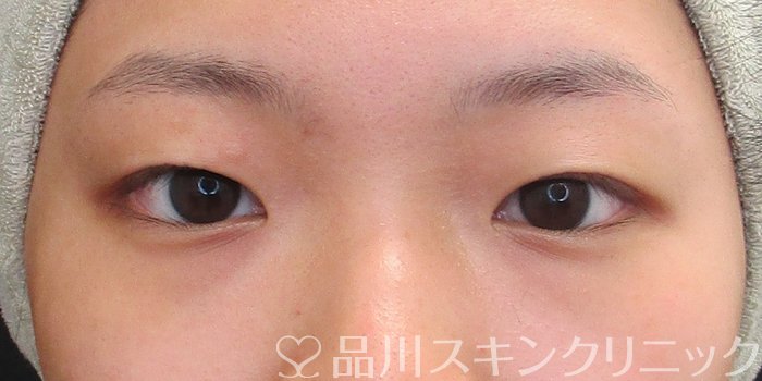 症例NO.73028のBEFORE写真