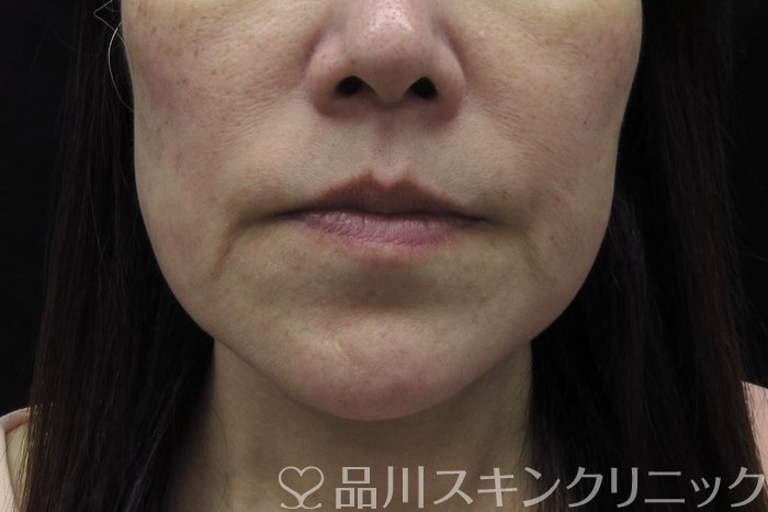 症例NO.74548のBEFORE写真