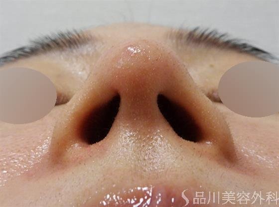 症例NO.51490のAFTER写真