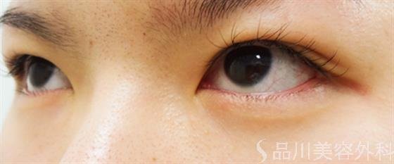 症例NO.33250のBEFORE写真