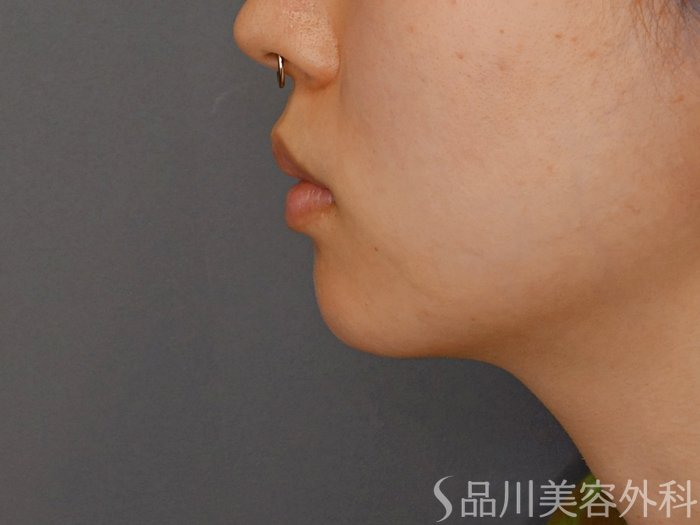症例NO.70191のBEFORE写真