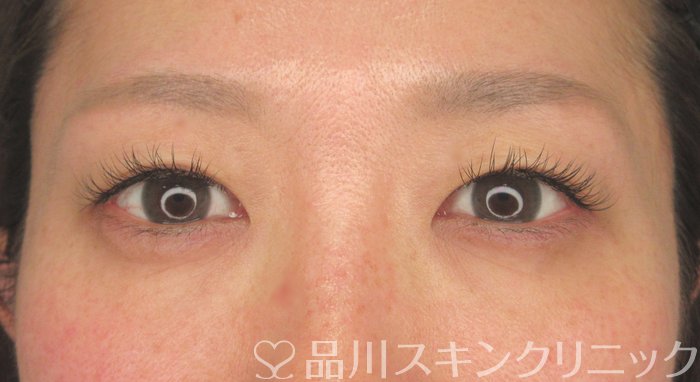 症例NO.69933のAFTER写真