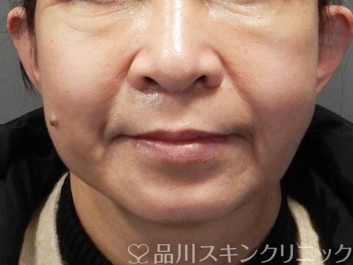 症例NO.72395のAFTER写真