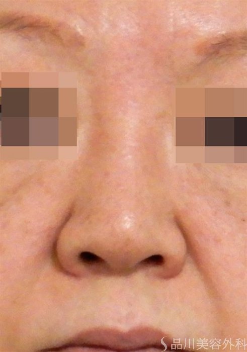 症例NO.42215のBEFORE写真