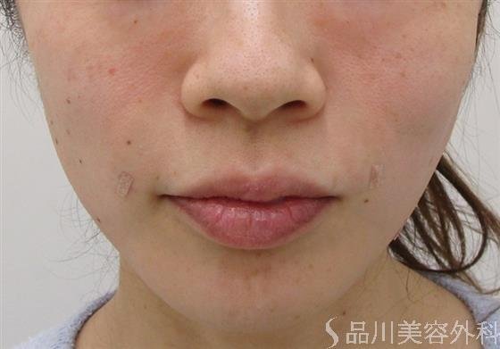 症例NO.43139のAFTER写真