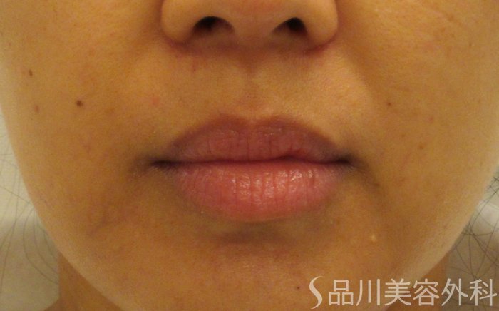 症例NO.70844のBEFORE写真