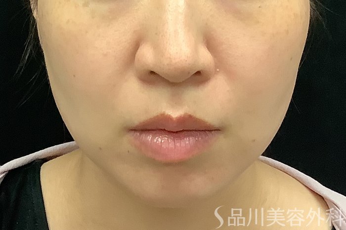 症例NO.71250のBEFORE写真
