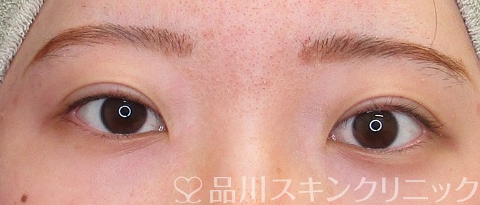 症例NO.73747のAFTER写真