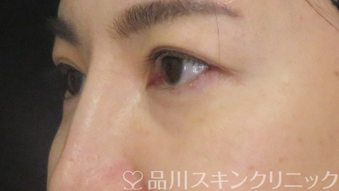 症例NO.71851のBEFORE写真