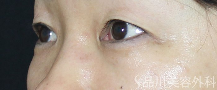 症例NO.72301のBEFORE写真