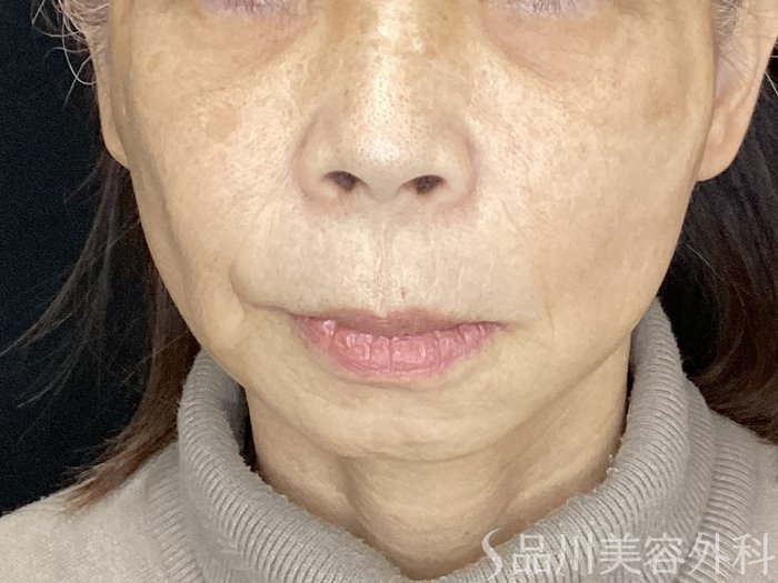 症例NO.72092のAFTER写真