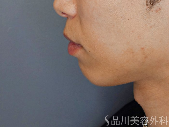 症例NO.70881のBEFORE写真