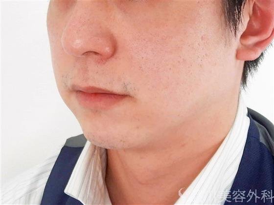 症例NO.60613のBEFORE写真