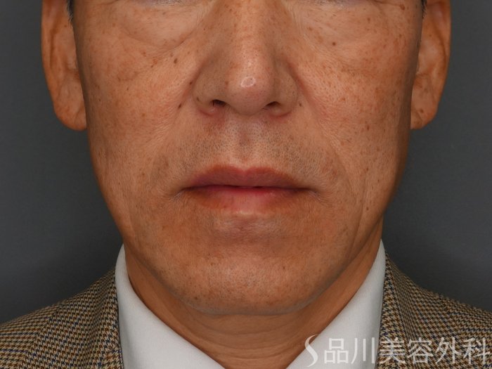 症例NO.75061のBEFORE写真