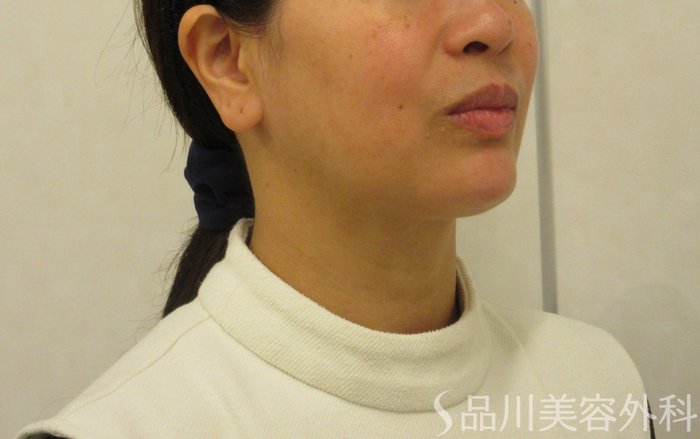 症例NO.72375のBEFORE写真