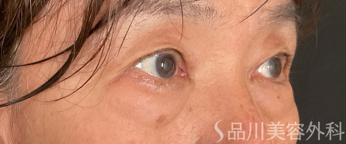 症例NO.75376のBEFORE写真
