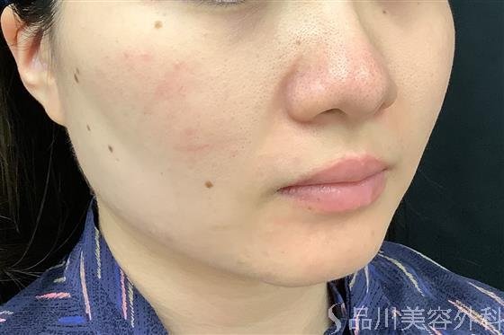 症例NO.60644のAFTER写真