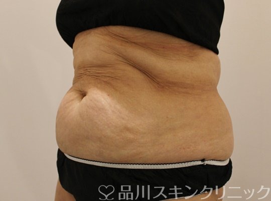 症例NO.73961のBEFORE写真