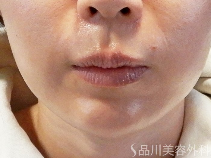 症例NO.65131のBEFORE写真