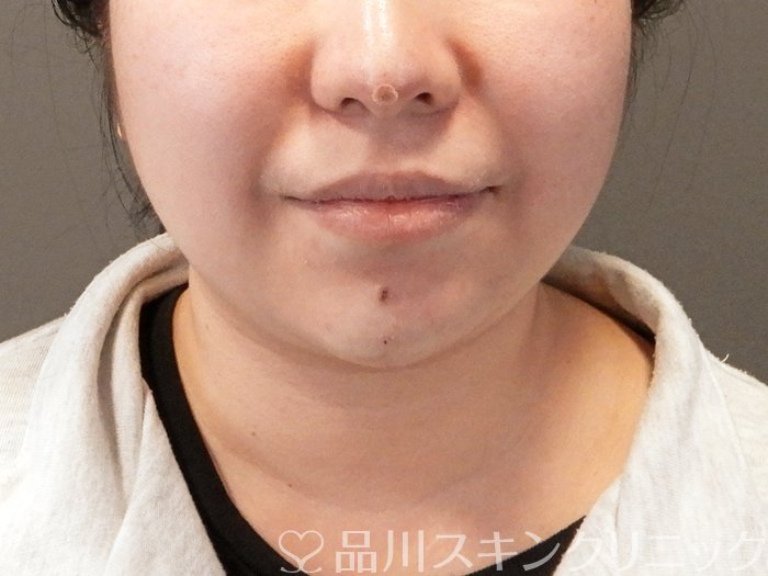 症例NO.64193のAFTER写真