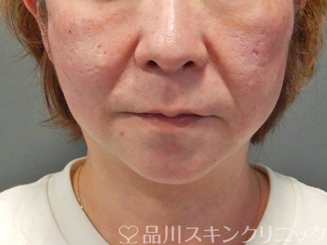 症例NO.75056のAFTER写真