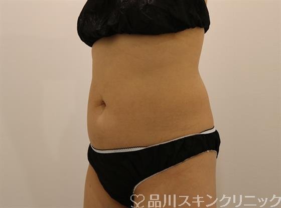 症例NO.43616のBEFORE写真
