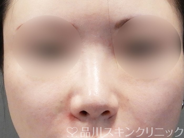 症例NO.72813のAFTER写真