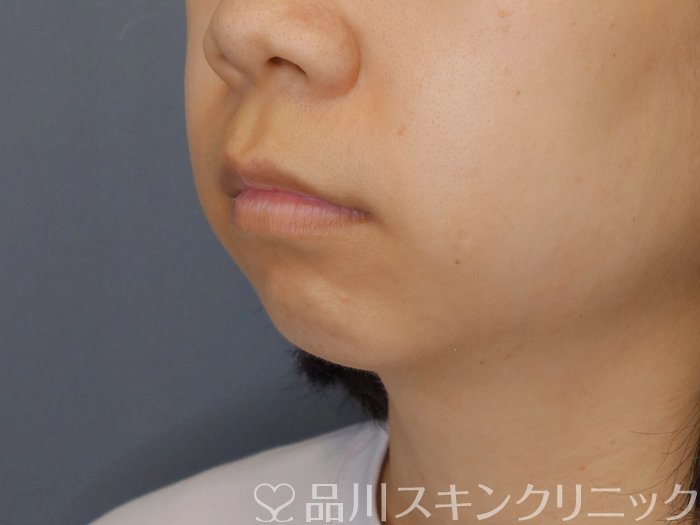 症例NO.71745のBEFORE写真