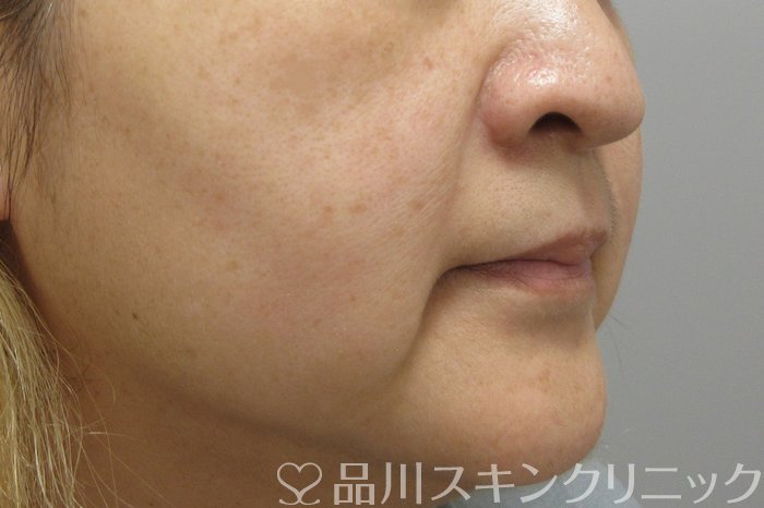 症例NO.70581のBEFORE写真