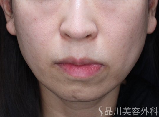 症例NO.74124のBEFORE写真
