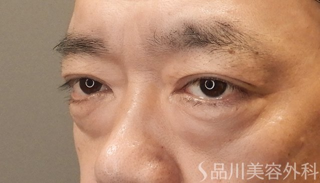 症例NO.75042のBEFORE写真