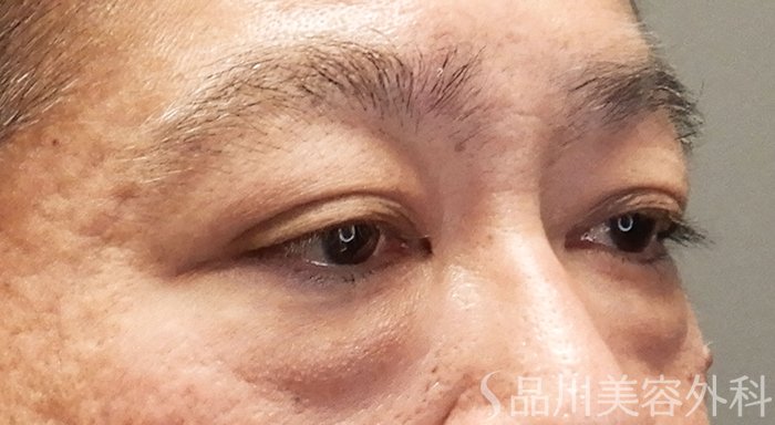 症例NO.69898のBEFORE写真
