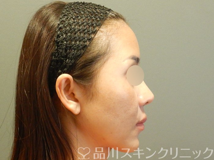 症例NO.65033のBEFORE写真
