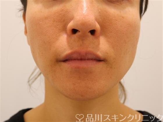 症例NO.38245のBEFORE写真