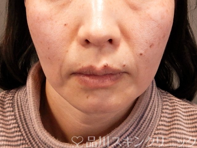 症例NO.70489のBEFORE写真