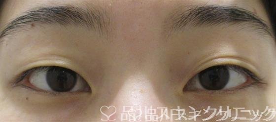 症例NO.65684のBEFORE写真